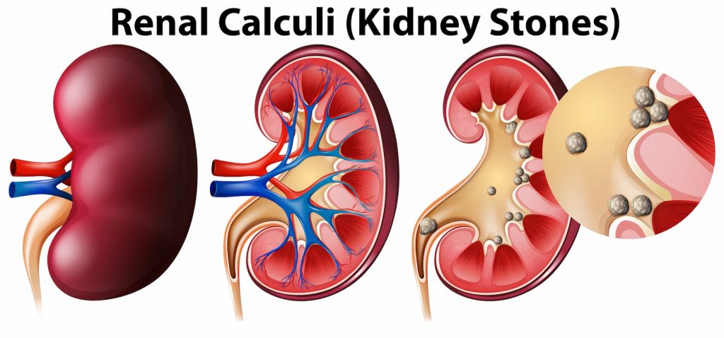 how long does it take for a kidney stone to pass prime wellness, How Long Does it Take to Pass a Kidney Stone, how long does it take to pass a kidney stone with flomax, how long to pass kidney stone, Kidney Stone, pure ohio wellness, restore hyper wellness, sleep and wellness centers, surterra wellness, theory wellness, ultimate guide, us wellness meats, wellness elements, xpress wellness